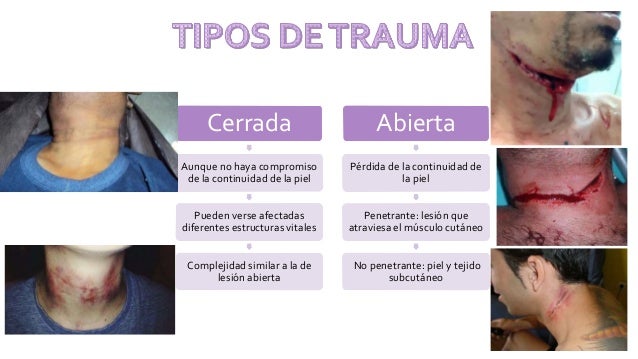 Hematoma Retrocorial Y Síndrome De Down