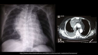 http://www.unboundedmedicine.com/2005/11/03/traumatic-mediastinal-hematoma/
 