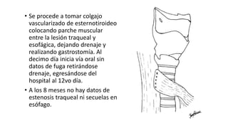 • Se procede a tomar colgajo
vascularizado de esternotiroideo
colocando parche muscular
entre la lesión traqueal y
esofágica, dejando drenaje y
realizando gastrostomía. Al
decimo día inicia vía oral sin
datos de fuga retirándose
drenaje, egresándose del
hospital al 12vo día.
• A los 8 meses no hay datos de
estenosis traqueal ni secuelas en
esófago.
 