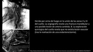 Herida por arma de fuego en la unión de las zonas II y III
del cuello. La angiografía revela una fractura mandibular y
una posible lesión de arteria carótida. B. La exploración
quirúrgica del cuello revela que no existía lesión vascular
(tras la realización de una endarterectomía).
http://www.elsevier.es/es-revista-angiologia-294-articulo-lesiones-vasculares-del-cuello-S0003317010700377
 