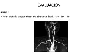 EVALUACIÓN
ZONA 3
- Arteriografia en pacientes estables con heridas en Zona III
 