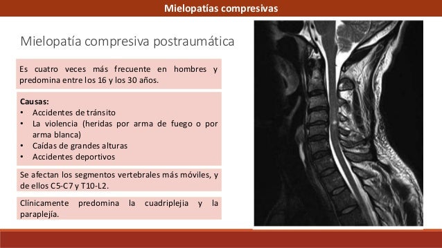 Hematoma Retrocorial Y Síndrome De Down
