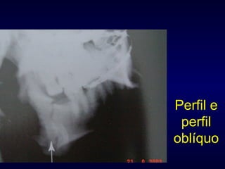 Perfil e perfil oblíquo 