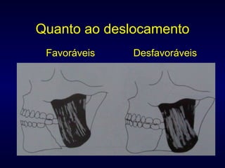 Quanto ao deslocamento   Favoráveis  Desfavoráveis  