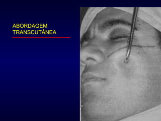 ABORDAGEM TRANSCUTÂNEA 