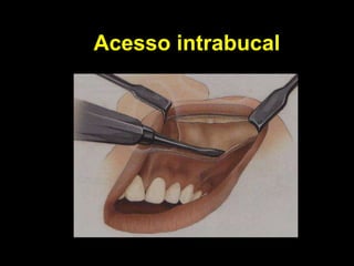 Acesso intrabucal 