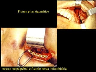 Acesso subpalpebral e fixação borda infraorbitária Fratura pilar zigomático 