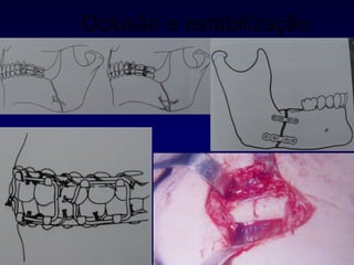 Oclusão e estabilização 