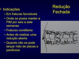 Redução Fechada Indicações Em fraturas favoráveis Onde se possa manter a FIM por seis a sete semanas Fraturas condilares Antes de realizar uma redução aberta Quando não se pode lançar mão de placas e parafusos 