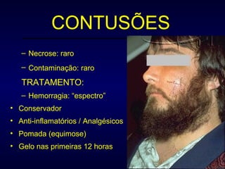 CONTUSÕES Necrose: raro Contaminação: raro   TRATAMENTO: Hemorragia: “espectro” Conservador Anti-inflamatórios / Analgésicos Pomada (equimose) Gelo nas primeiras 12 horas 