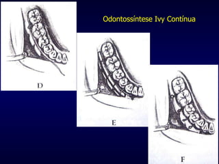 Odontossíntese Ivy Contínua 