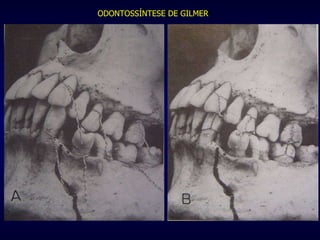 ODONTOSSÍNTESE DE GILMER 