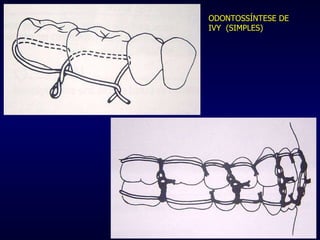ODONTOSSÍNTESE DE IVY  (SIMPLES) 