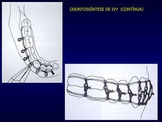ODONTOSSÍNTESE DE IVY  (CONTÍNUA) 