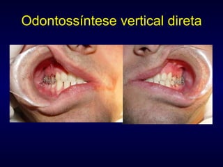 Odontossíntese vertical direta 