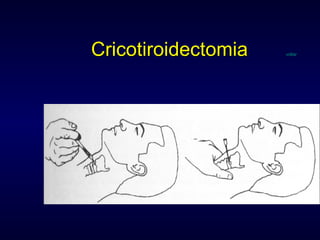 Cricotiroidectomia  voltar 