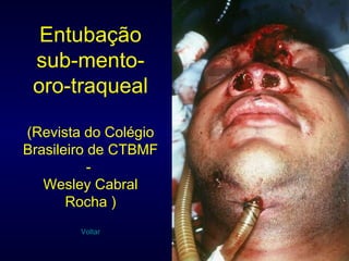 Entubação sub-mento-oro-traqueal (Revista do Colégio Brasileiro de CTBMF -  Wesley Cabral Rocha ) Voltar 