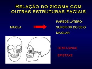 Relação do zigoma com outras estruturas faciais PAREDE LÁTERO- MAXILA  SUPERIOR DO SEIO MAXILAR HEMO-SINUS EPISTAXE 