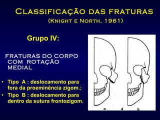 Classificação das fraturas   (Knight e North, 1961) Grupo IV: FRATURAS DO CORPO COM  ROTAÇÃO MEDIAL Tipo  A : deslocamento para fora da proeminência zigom.; Tipo  B : deslocamento para dentro da sutura frontozigom. 