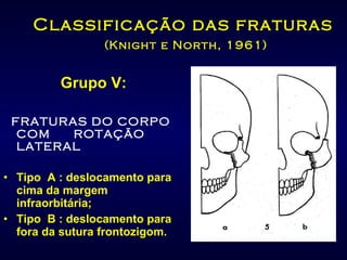 Classificação das fraturas   (Knight e North, 1961) Grupo V: FRATURAS DO CORPO COM  ROTAÇÃO LATERAL Tipo  A : deslocamento para cima da margem infraorbitária; Tipo  B : deslocamento para fora da sutura frontozigom. 