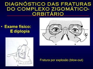 DIAGNÓSTICO DAS FRATURAS DO COMPLEXO ZIGOMÁTICO-ORBITÁRIO Exame físico:    diplopia Fratura por explosão (blow-out) 