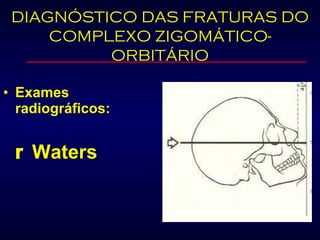 Exames radiográficos:     Waters DIAGNÓSTICO DAS FRATURAS DO COMPLEXO ZIGOMÁTICO-ORBITÁRIO 
