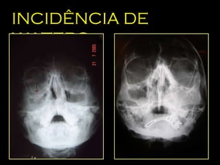 INCIDÊNCIA DE WATERS 