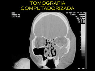 TOMOGRAFIA COMPUTADORIZADA 