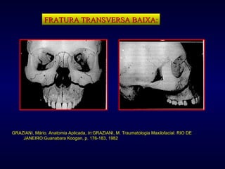 FRATURA TRANSVERSA BAIXA: GRAZIANI, Mário. Anatomia Aplicada,  In :GRAZIANI, M. Traumatologia Maxilofacial. RIO DE JANEIRO:Guanabara Koogan, p. 176-183, 1982 . 