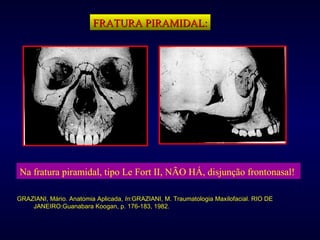 FRATURA PIRAMIDAL: Na fratura piramidal, tipo Le Fort II, NÃO HÁ, disjunção frontonasal!   GRAZIANI, Mário. Anatomia Aplicada,  In :GRAZIANI, M. Traumatologia Maxilofacial. RIO DE JANEIRO:Guanabara Koogan, p. 176-183, 1982. 