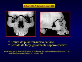 FRATURA tipo Le Fort III: * Rotura do pilar transverso da face; * Sentido da força geralmente supero-inferior. GRAZIANI, Mário. Anatomia Aplicada,  In :GRAZIANI, M. Traumatologia Maxilofacial. RIO DE JANEIRO:Guanabara Koogan, p. 176-183, 1982. 