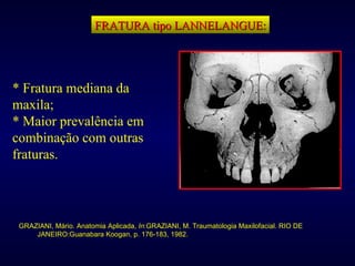 FRATURA tipo LANNELANGUE: GRAZIANI, Mário. Anatomia Aplicada,  In :GRAZIANI, M. Traumatologia Maxilofacial. RIO DE JANEIRO:Guanabara Koogan, p. 176-183, 1982. * Fratura mediana da maxila; * Maior prevalência em combinação com outras fraturas. 