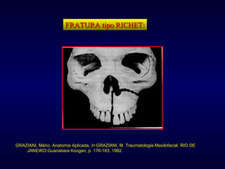 FRATURA tipo RICHET: GRAZIANI, Mário. Anatomia Aplicada,  In :GRAZIANI, M. Traumatologia Maxilofacial. RIO DE JANEIRO:Guanabara Koogan, p. 176-183, 1982. 