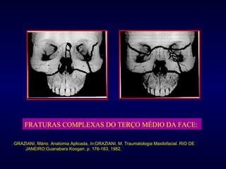 FRATURAS COMPLEXAS DO TERÇO MÉDIO DA FACE:   GRAZIANI, Mário. Anatomia Aplicada,  In :GRAZIANI, M. Traumatologia Maxilofacial. RIO DE JANEIRO:Guanabara Koogan, p. 176-183, 1982. 
