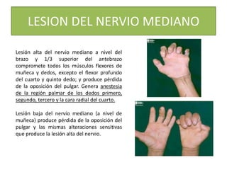 LESION DEL NERVIO MEDIANO
Lesión alta del nervio mediano a nivel del
brazo y 1/3 superior del antebrazo
compromete todos los músculos flexores de
muñeca y dedos, excepto el flexor profundo
del cuarto y quinto dedo; y produce pérdida
de la oposición del pulgar. Genera anestesia
de la región palmar de los dedos primero,
segundo, tercero y la cara radial del cuarto.
Lesión baja del nervio mediano (a nivel de
muñeca) produce pérdida de la oposición del
pulgar y las mismas alteraciones sensitivas
que produce la lesión alta del nervio.
 