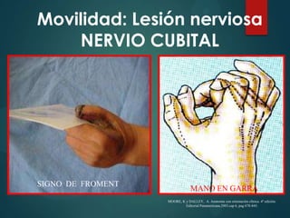 Nervio Cubital Mano En Garra