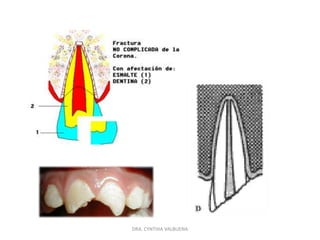 FRACTURAS CORONALESDRA. CYNTHIA VALBUENA