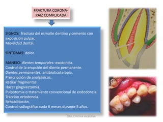 FRACTURAS CORONO-RADICULARDRA. CYNTHIA VALBUENA