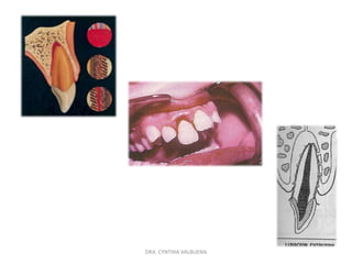 LUXACIÓN INTRUSIVASIGNOS:diente temporal: desplazamiento dentro de su alveolo.Diente permanente: generalmente se asocia a luxación lateral.Edema.Hemorragia.Puede o no haber movilidad dental.Prueba a la percusión sordo metálico.SÍNTOMAS: dolor.HALLAZGOS PARACLINICOS Y RADIOLÓGICOS: diente temporal: perdida o compresión del ligamento.Valorar la dirección de la intrusión y la relación con el permanente.Dientes permanente: perdida del espacio del ligamento periodontal.Valorar la formación radicular.DRA. CYNTHIA VALBUENA