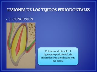 • 1. CONCUSION 
El trauma afecta solo el 
ligamento periodontal, sin 
aflojamiento ni desplazamiento 
del diente 
 