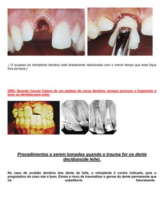 ( O sucesso do reimplante dentário está diretamente relacionado com o menor tempo que esse fique
fora da boca.)
OBS: Quando houver fratura de um pedaço da coroa dentária, sempre procurar o fragmento e
levar ao dentista para colar.
Procedimentos a serem tomados quando o trauma for no dente
decíduos(de leite).
No caso de avulsão dentária dos dente de leite, o reimplante é contra indicado, pois o
prognóstico do caso não é bom. Existe o risco de traumatizar o germe do dente permanente que
irá substituí-lo futuramente.
 