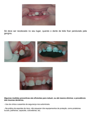 Só deve ser recolocado no seu lugar, quando o dente de leite ficar pendurado pela
gengiva.
Algumas medidas preventivas são eficientes para reduzir, ou até mesmo eliminar, a prevalência
dos traumas dentários.
- Uso de cintos e assentos de segurança nos automóveis.
- Na prática de esportes de risco, não esquecer dos equipamentos de proteção, como protetores
bucais, joelheiras, capacete, cotoveleiras, etc.
 