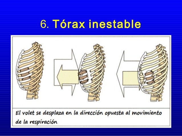 Trauma de torax Trauma de torax