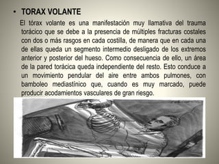 • TORAX VOLANTE
El tórax volante es una manifestación muy llamativa del trauma
torácico que se debe a la presencia de múltiples fracturas costales
con dos o más rasgos en cada costilla, de manera que en cada una
de ellas queda un segmento intermedio desligado de los extremos
anterior y posterior del hueso. Como consecuencia de ello, un área
de la pared torácica queda independiente del resto. Esto conduce a
un movimiento pendular del aire entre ambos pulmones, con
bamboleo mediastínico que, cuando es muy marcado, puede
producir acodamientos vasculares de gran riesgo.
 