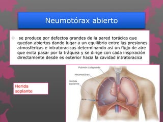 Neumotórax abierto
 se produce por defectos grandes de la pared torácica que
quedan abiertos dando lugar a un equilibrio entre las presiones
atmosféricas e intratoracicas determinando asi un flujo de aire
que evita pasar por la tráquea y se dirige con cada inspiración
directamente desde es exterior hacia la cavidad intratoracica
Herida
soplante
 