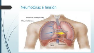 Neumotórax a Tensión
 