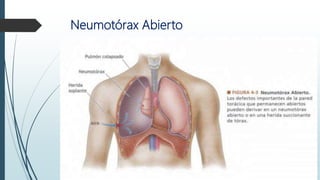 Neumotórax Abierto
 