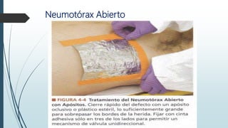 Neumotórax Abierto
 