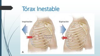 Tórax Inestable
 