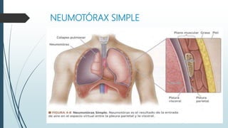 NEUMOTÓRAX SIMPLE
 